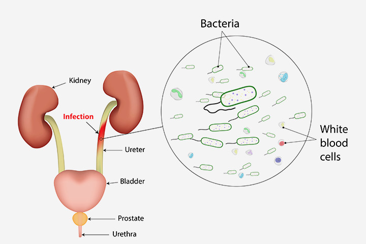 Uti when pregnant treatment